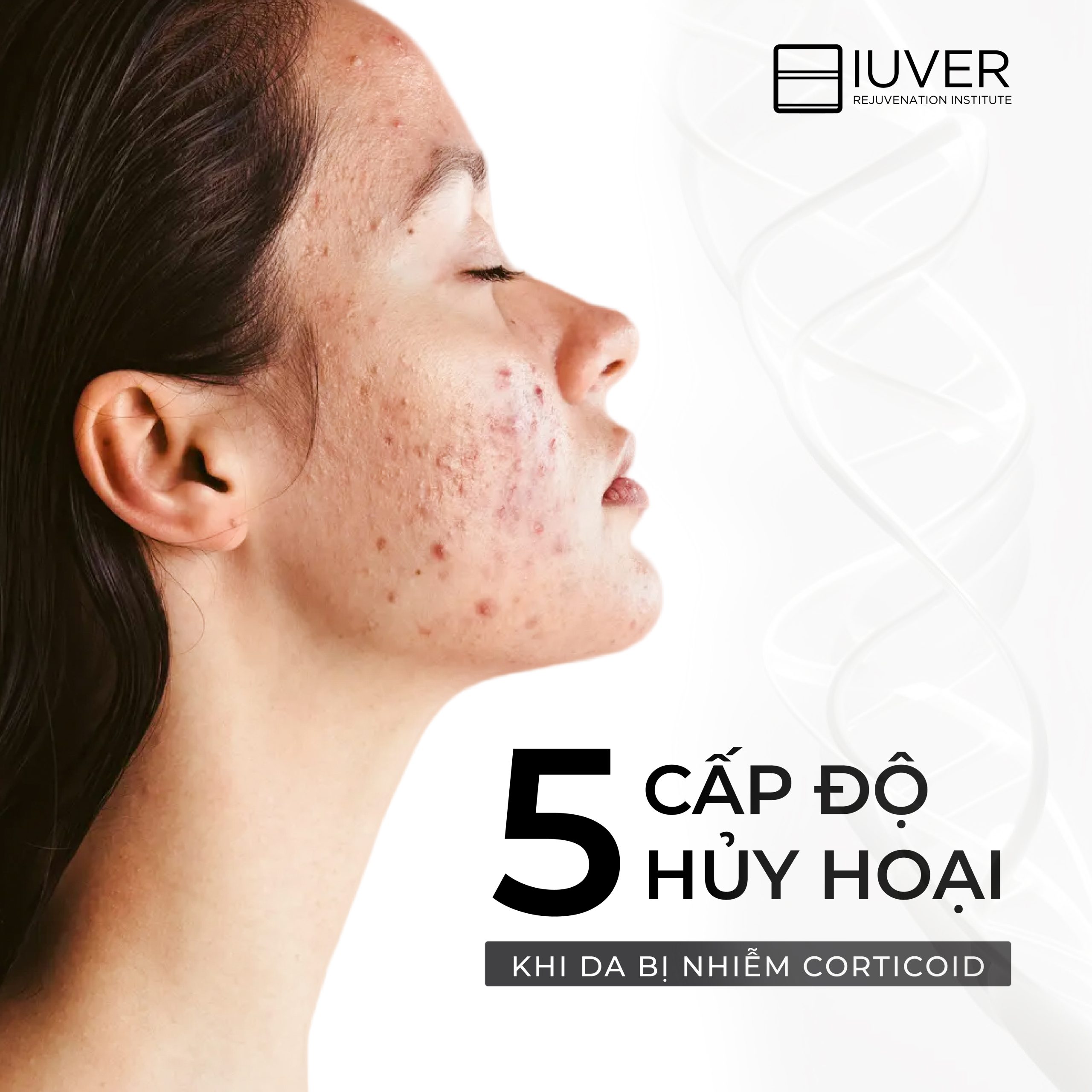 5 CẤP ĐỘ HỦY HOẠI LÀN DA KHI NHIỄM CORTICOID