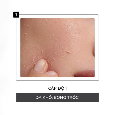 Cấp độ đầu tiên hủy hoại da khi nhiễm Corticoid
