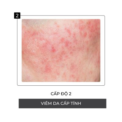 Cấp độ thứ 2 hủy hoại da khi nhiễm Corticoid