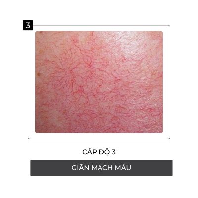 Cấp độ thứ 3 hủy hoại da khi nhiễm Corticoid