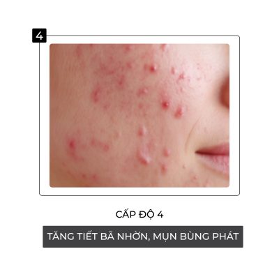 Cấp độ thứ 4 hủy hoại da khi nhiễm Corticoid
