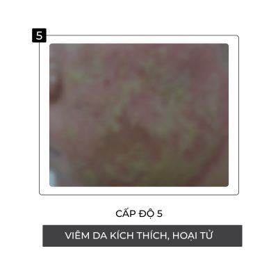 Cấp độ thứ 5 hủy hoại da khi nhiễm Corticoid